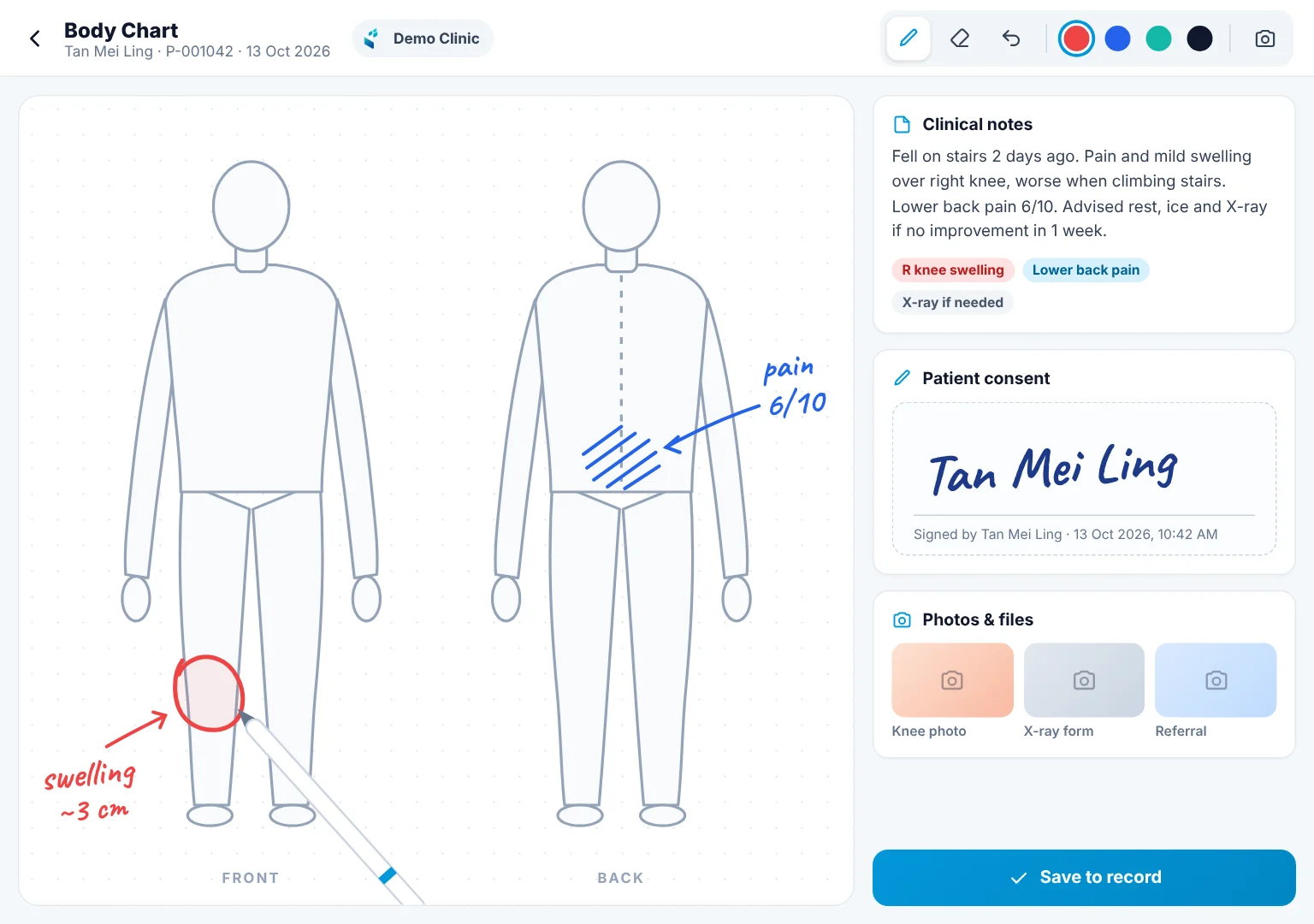 iPad body chart with the doctor's hand-drawn notes and the patient's digital consent signature